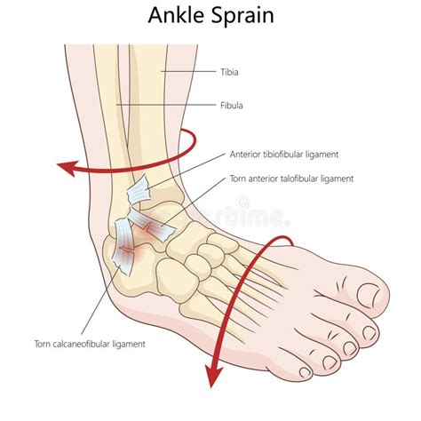 Illustration showing common ankle ligament injuries affecting NBA players like Robinson.